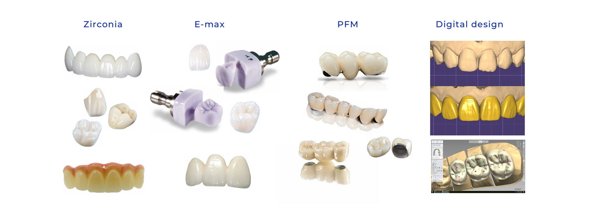 Digital zirconia, E-max, and PFM crown, bridge, and veneer restorations