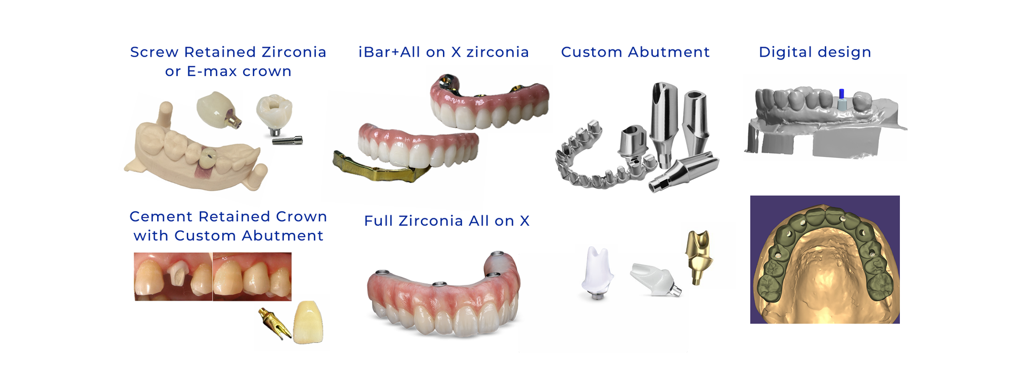Custom implant abutments and full-arch zirconia iBar / All-on-X solutions