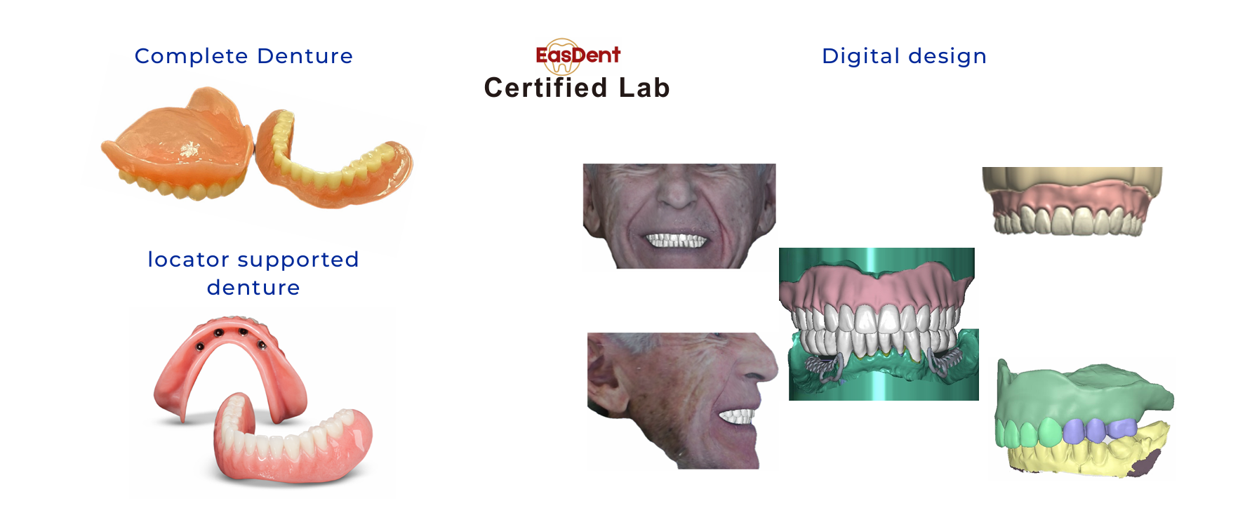 EasDent-certified two-visit digital complete denture solutions