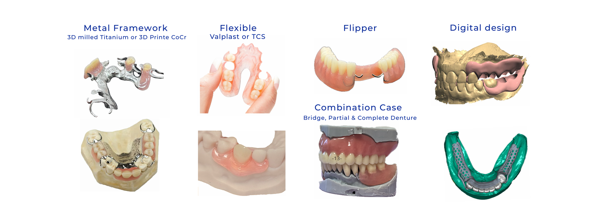 Digital removable partial dentures with metal or flexible frameworks